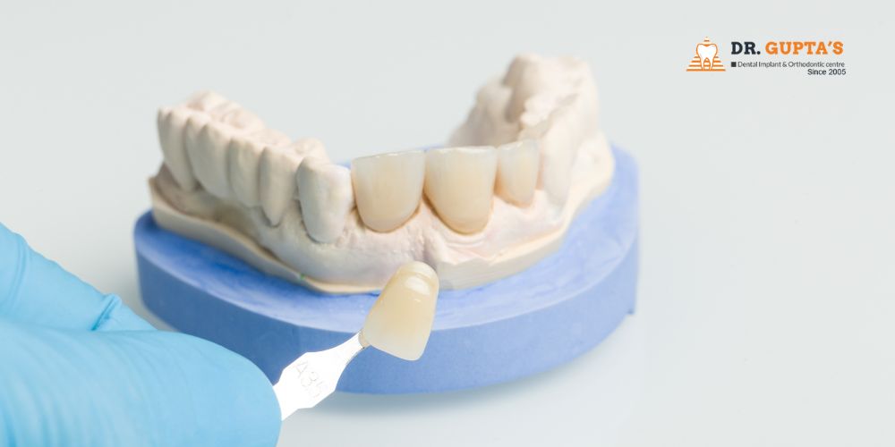 Dental Veneers in Gurgaon