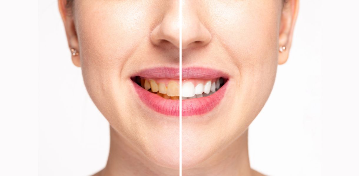 Teeth Whitening in Gurgaon