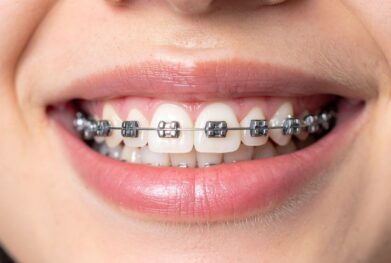 Orthodontist in Gurgaon