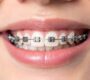 Orthodontic Treatment 90x80