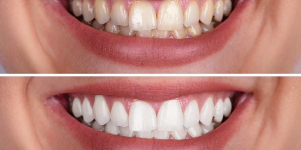 Teeth whitening In Gurgaon