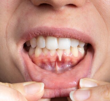 Periodontal treatment