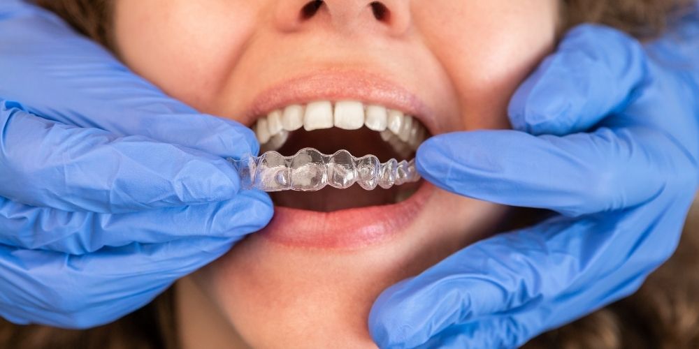 Invisible Braces in Gurgaon