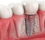 Dental Implants 90x80