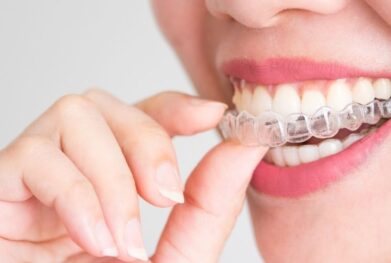 Invisible Braces in Gurgaon