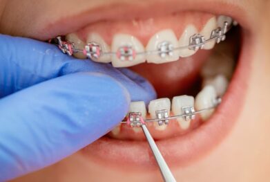 Orthodontist in Gurgaon