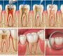 Root Canal Treatment  90x80