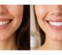 Smile Makeover 90x80