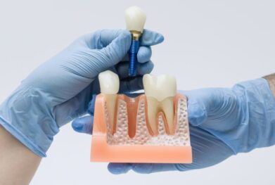 Dental implants in Gurgaon