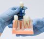 Dental Implants 1 90x80