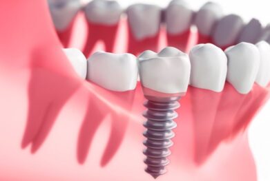 Dental implants in Gurgaon