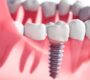 Dental Implants 90x80