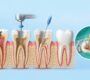 Root Canal Treatment 90x80