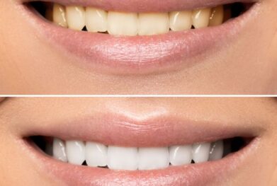 Teeth whitening In Gurgaon