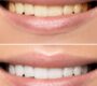 Teeth whitening In Gurgaon 90x80