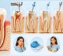Root Canal Treatment 1 90x80