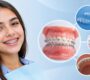 Braces Treatment 90x80