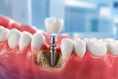 Dental Implants