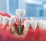 Dental Implants 90x80