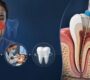 Root Canal Treatment 2 90x80