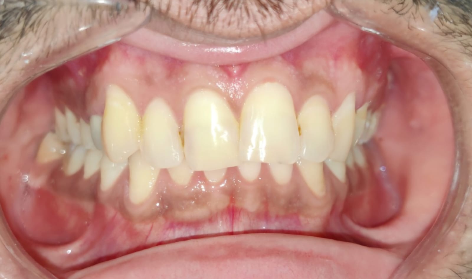 Frontal view of the bite before treatment, showing crowded and inward-tilted upper front teeth
