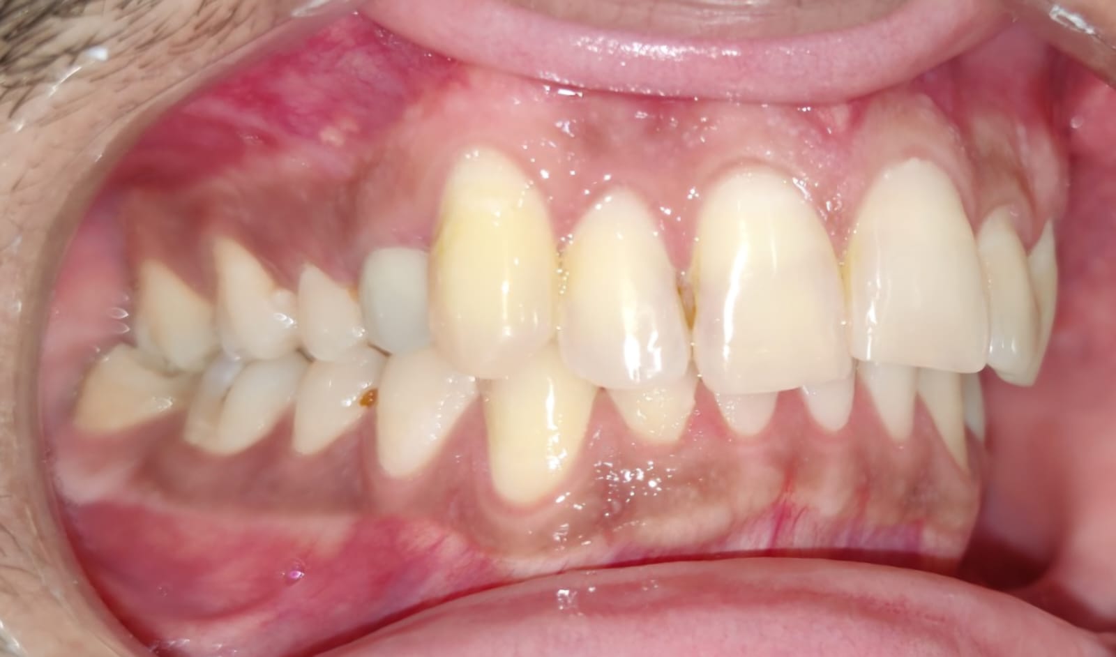 Side view of the bite before treatment, showing posterior crossbite