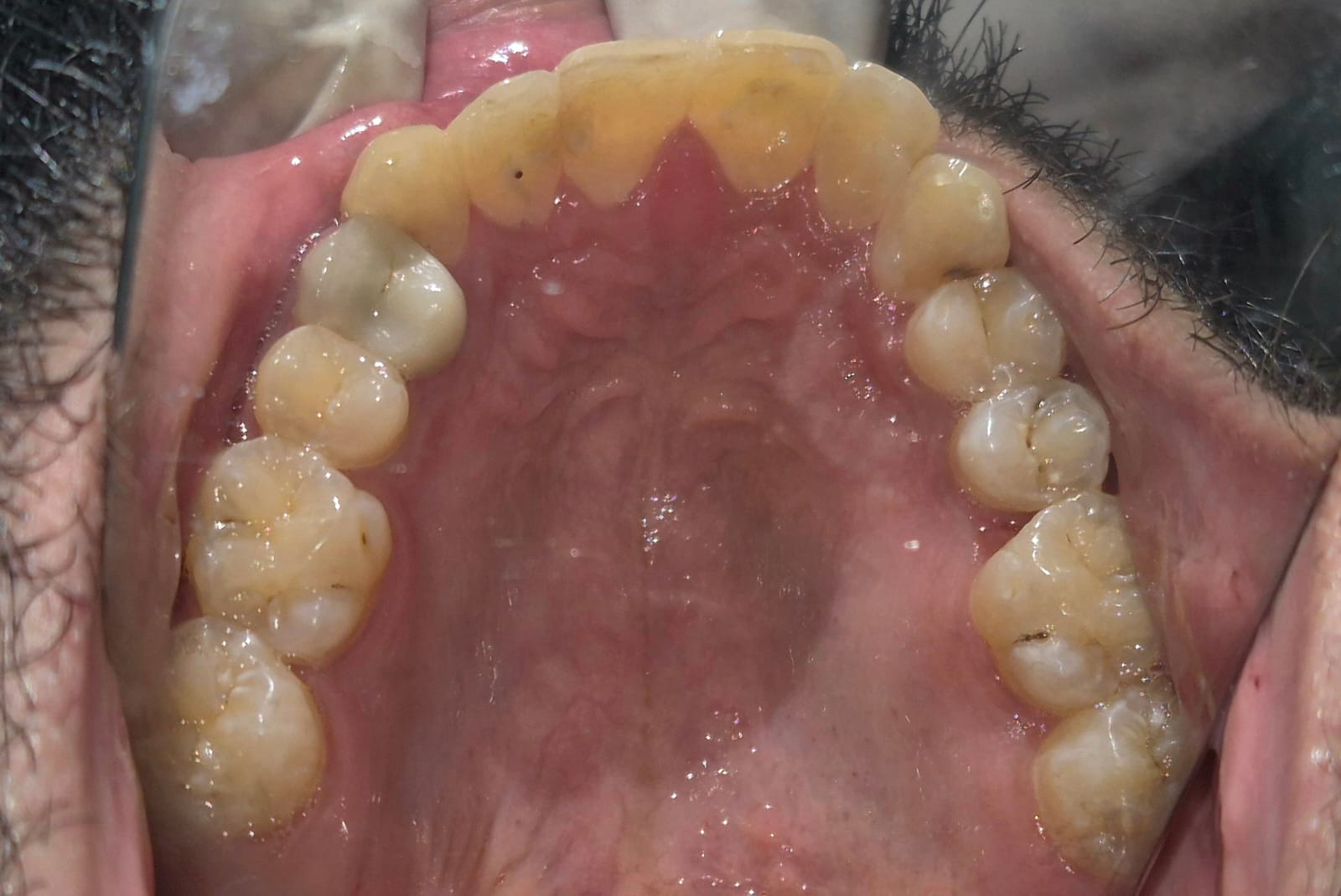Occlusal view of upper arch after clear aligner treatment, showing corrected alignment and proper arch form
