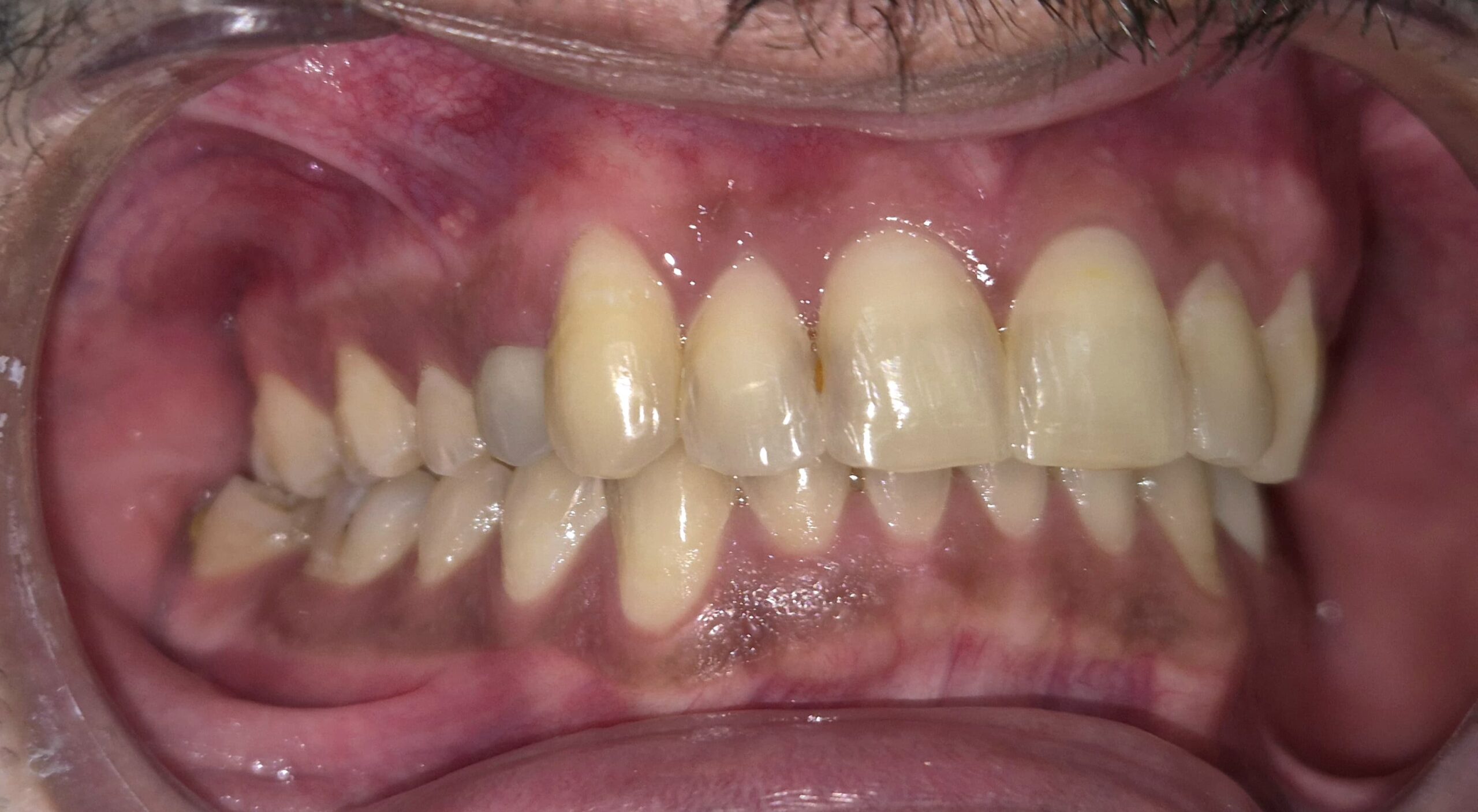 Side view of the bite after clear aligner treatment, showing corrected crossbite relationship