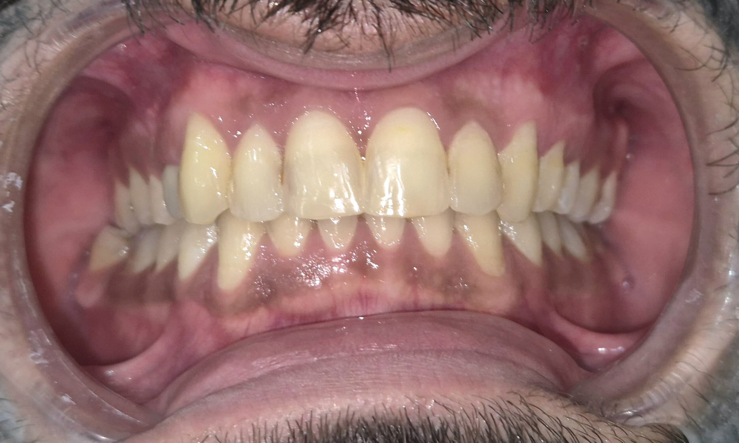 Frontal view of the bite after clear aligner treatment, showing corrected alignment of the upper front teeth