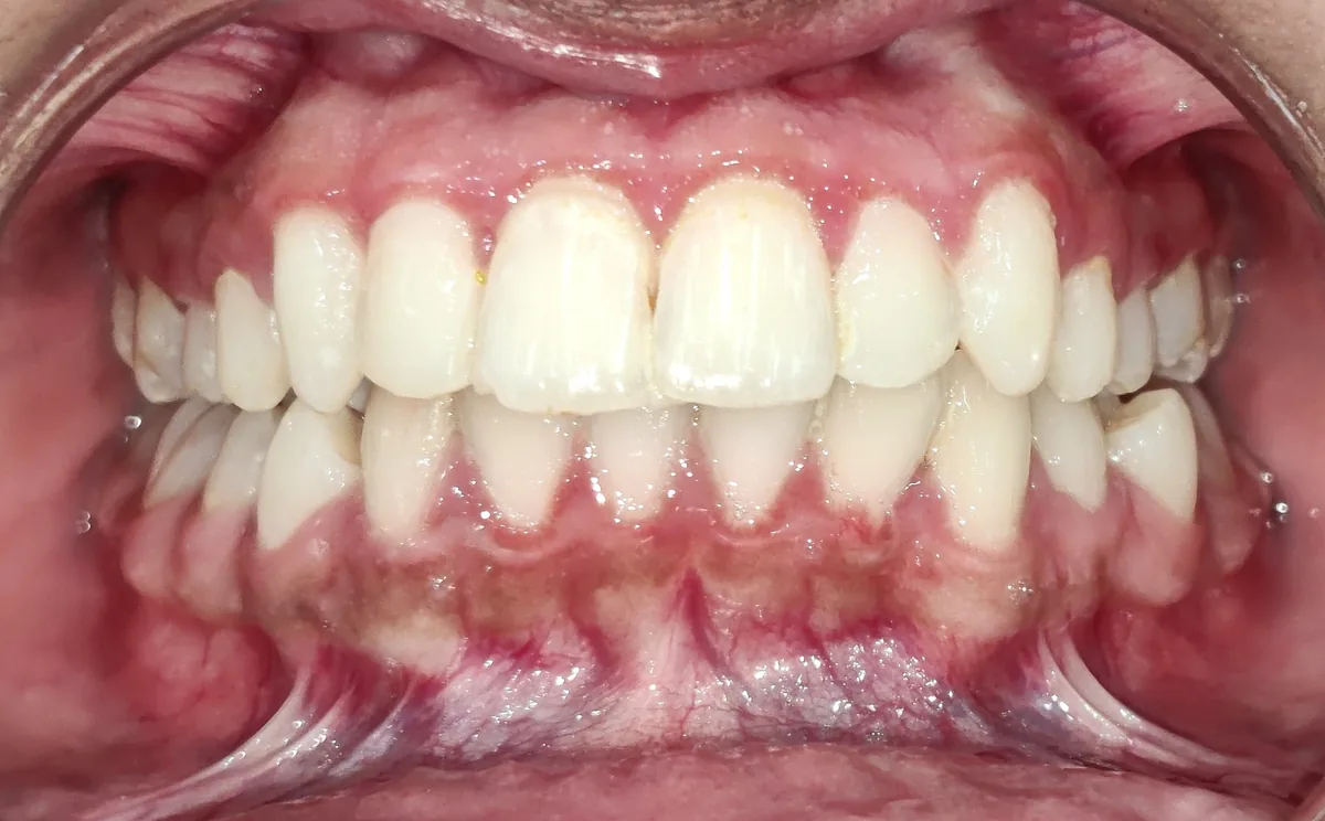 Front view of straight, aligned teeth after 15 months of clear aligner treatment