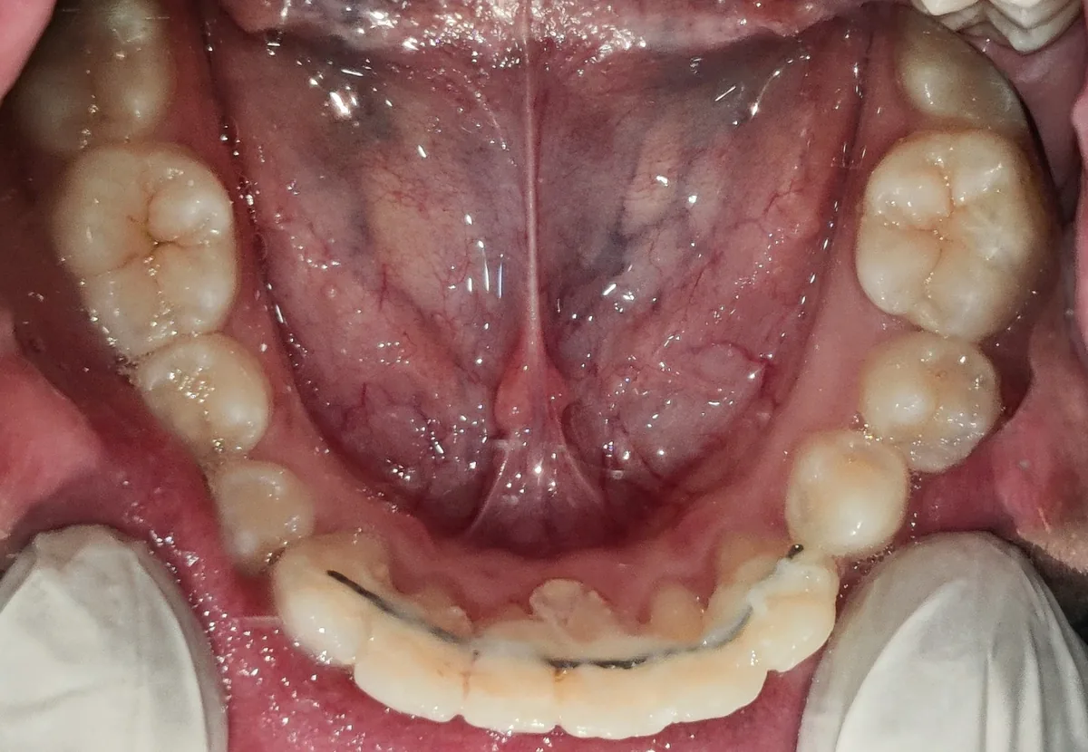 Lower arch after aligner treatment with a bonded lingual retainer behind the front teeth
