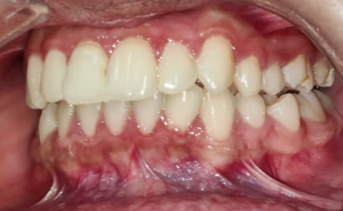 Side view of the bite after clear aligner treatment