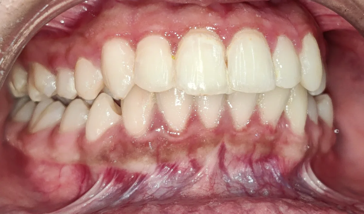 Opposite side view of the bite after clear aligner treatment