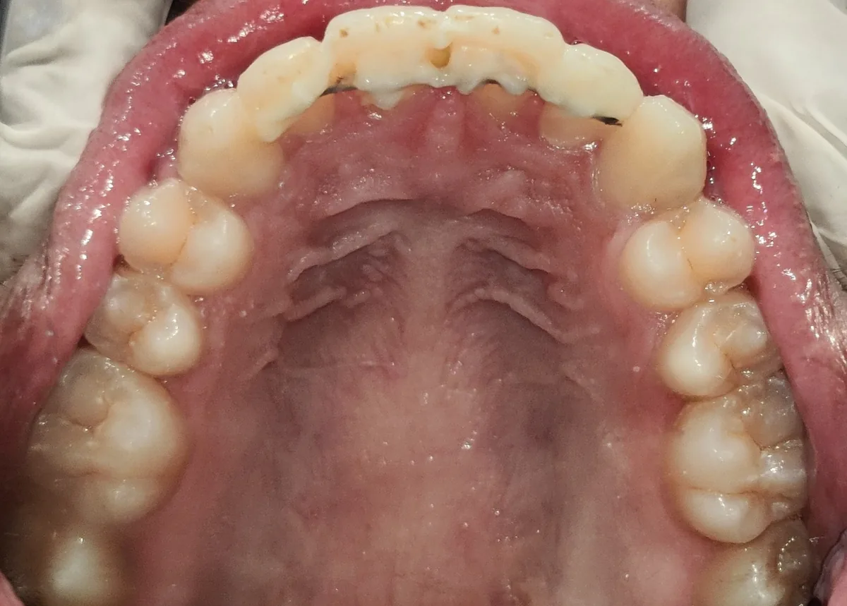 Upper arch after aligner treatment with a bonded lingual retainer behind the front teeth