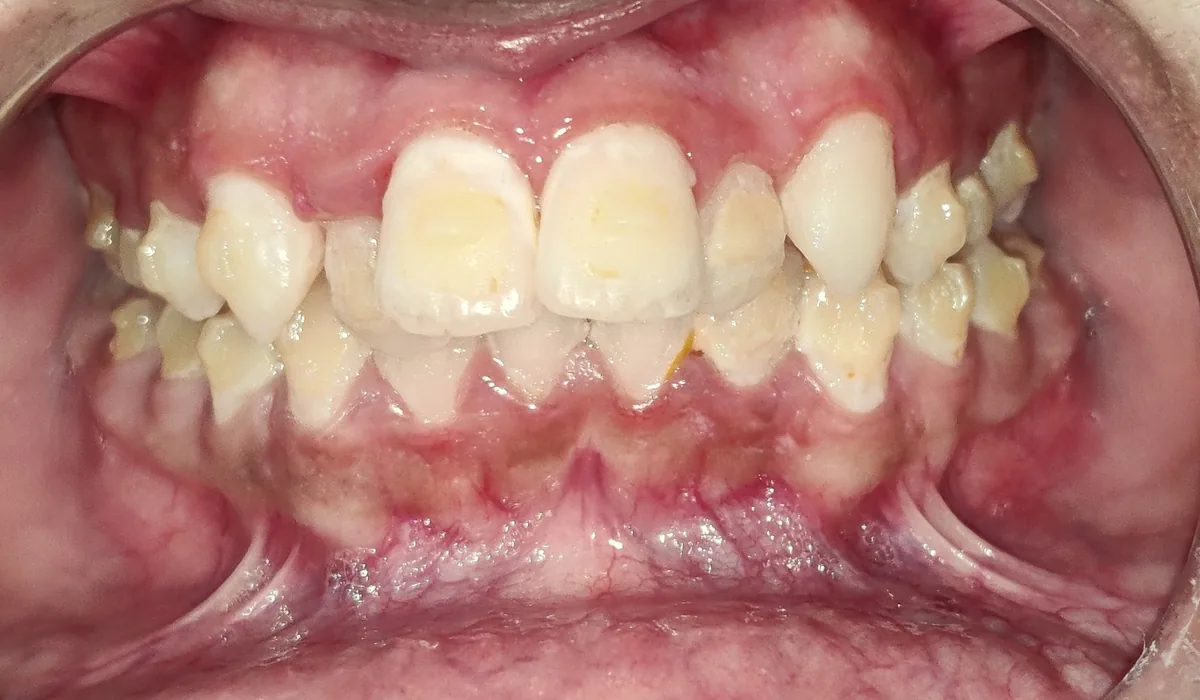 Front view of irregular, crowded teeth before the aligner treatment was restarted
