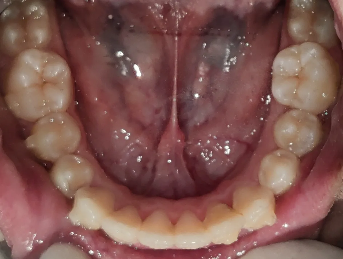 Lower arch view showing crowded, overlapping front teeth before treatment