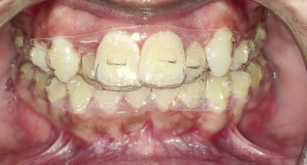Ill-fitting at-home aligner showing a gap over the front teeth before treatment