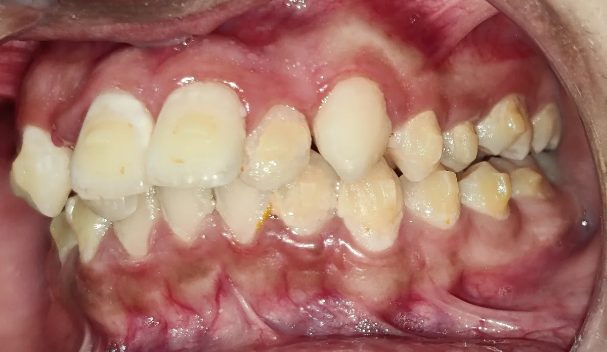 Side view of the bite before treatment showing a set-back lateral incisor and prominent canine