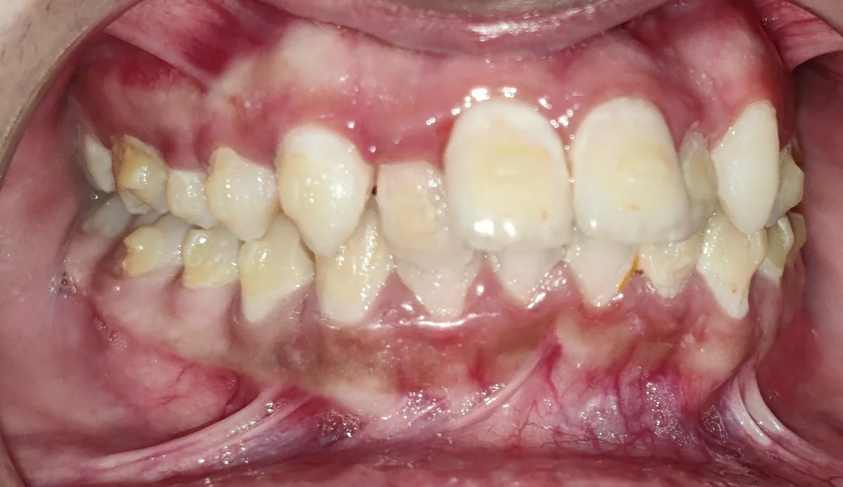 Opposite side view of the bite before clear aligner treatment