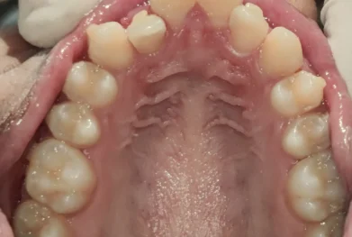 aligner-rescue-before-upper-arch