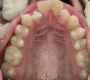 aligner rescue before upper arch 1 90x80