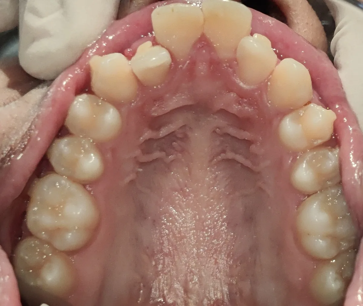 aligner-rescue-before-upper-arch