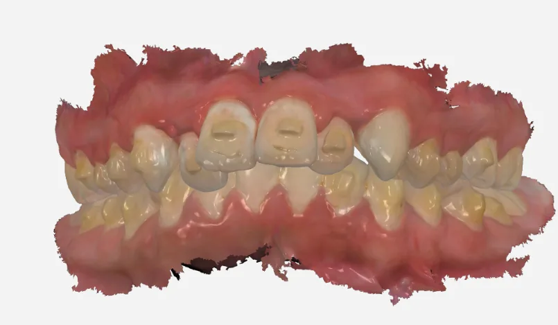 Mid-treatment 3D scan front view of the bite used to plan refinement aligners