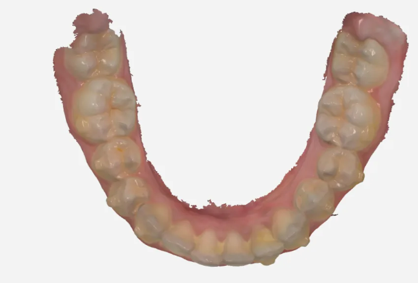 Mid-treatment 3D intraoral scan of the lower arch