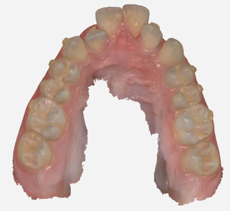 Mid-treatment 3D intraoral scan of the upper arch during CONFISMILE aligner treatment