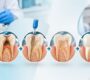 Root Canal Treatment 1 90x80