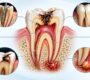 Root Canal Treatment 90x80