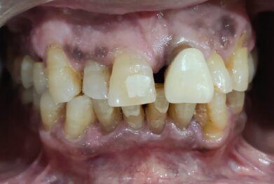 chipped gapped front teeth before zirconia bridge gurugram