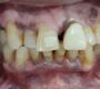 chipped gapped front teeth before zirconia bridge gurugram 90x80
