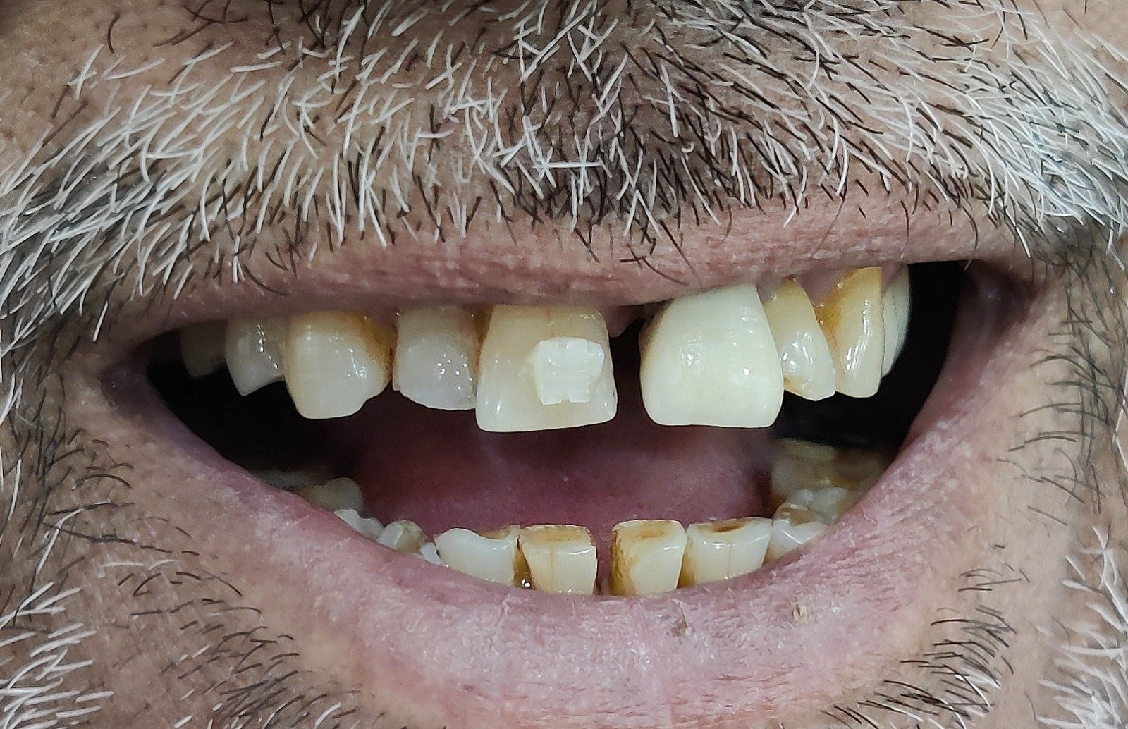 Before treatment smile view showing spacing, chipping and staining of the upper front teeth